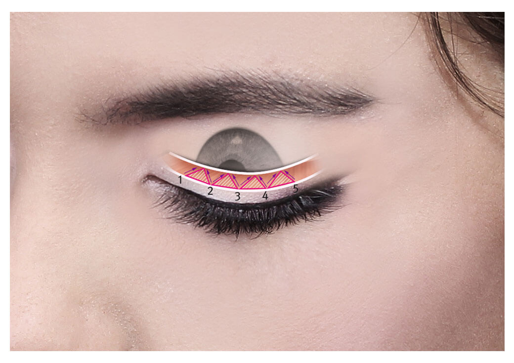 ทําตาสองชั้น กับหมอชั้นนำเกาหลี เฉพาะทางด้านตา ผู้เขียนตำราศัลยกรรมตาโดยตรง  - Gyalumhan Surgery Thailand